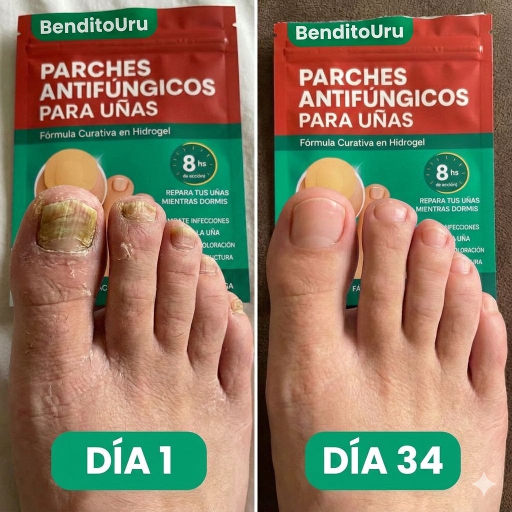 BenditoUru - Parches Antihongos - Eliminan Hongos y Regeneran tus Uñas