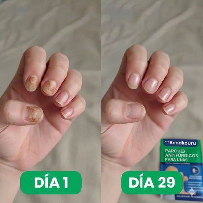 BenditoUru - Parches Antihongos - Eliminan Hongos y Regeneran tus Uñas