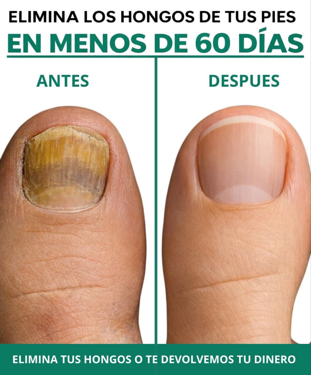 BenditoUru - Parches Antihongos - Eliminan Hongos y Regeneran tus Uñas